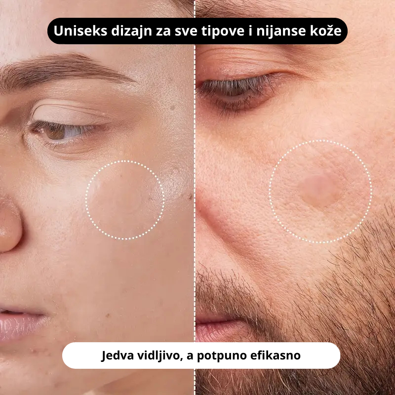 Uniseks flasteri za bubuljice – za sve tipove i nijanse kože